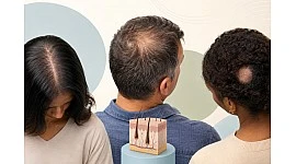 Tipos de alopecia y caída del cabello: guía general